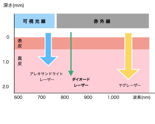 大阪・難波の医療全身脱毛でヴィーナスヴェロシティを導入している桜川よしえクリニックのレーザの種類