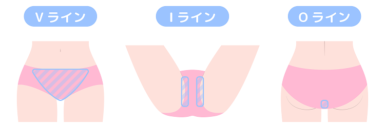 大阪・難波・心斎橋のVIO脱毛でヴィーナスヴェロシティを導入している桜川よしえクリニックのVIO脱毛の部位の説明