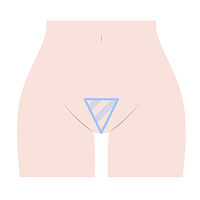 大阪・難波・心斎橋のVIO脱毛でヴィーナスヴェロシティを導入している桜川よしえクリニックのVIO脱毛デザイン種類