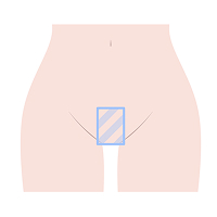 大阪・難波・心斎橋のVIO脱毛でヴィーナスヴェロシティを導入している桜川よしえクリニックのVIO脱毛デザイン種類