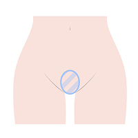 大阪・難波・心斎橋のVIO脱毛でヴィーナスヴェロシティを導入している桜川よしえクリニックのVIO脱毛デザイン種類