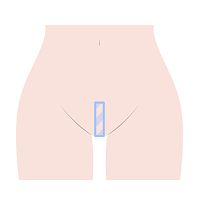 大阪・難波・心斎橋のVIO脱毛でヴィーナスヴェロシティを導入している桜川よしえクリニックのVIO脱毛デザイン種類