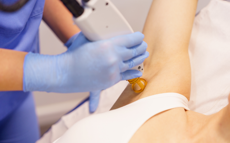 大阪・難波・心斎橋のVIO脱毛でヴィーナスヴェロシティを導入している桜川よしえクリニックのレーザー照射